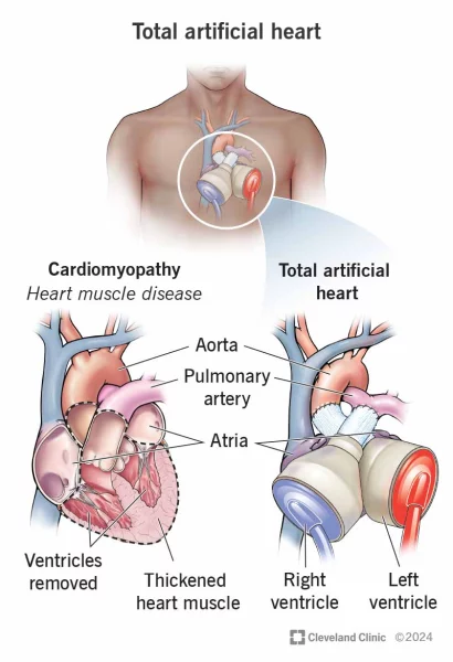A simulation of the artificial heart with a two-chamber pumping structure, similar to the human heart