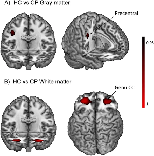 Reduced gray matter volume in the brain can affect memory and emotional regulation