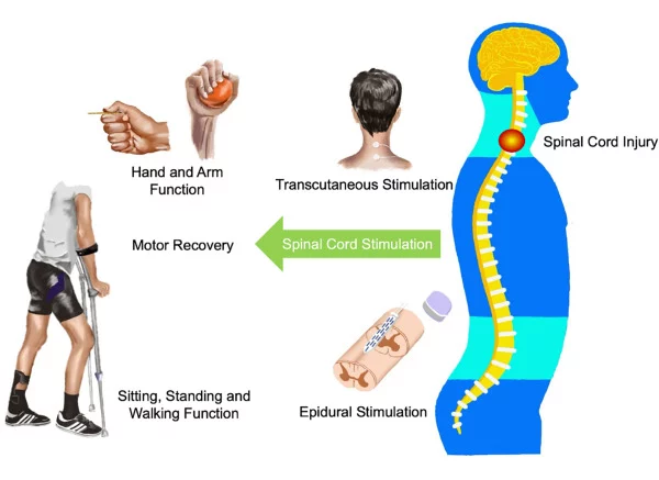 Simulation of spinal stimulation to aid in the restoration of motor function.