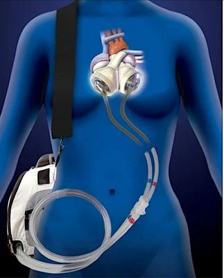 The 50cc SynCardia artificial heart in operation inside the human body