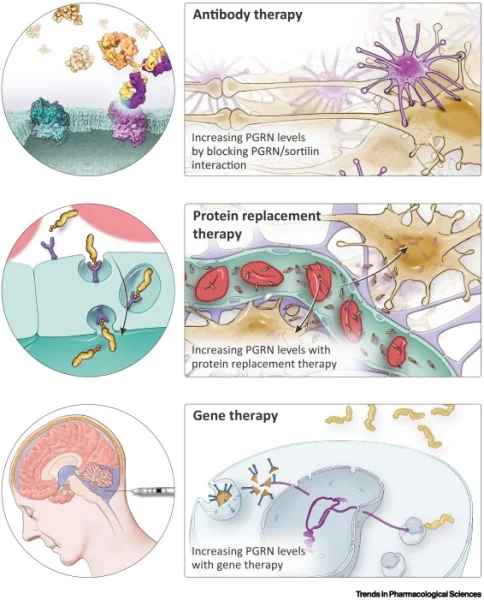 The PGRN protein analysis method in blood helps detect Alzheimer’s disease early