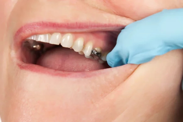 Tooth decay is one of the common consequences of consuming too much sugar